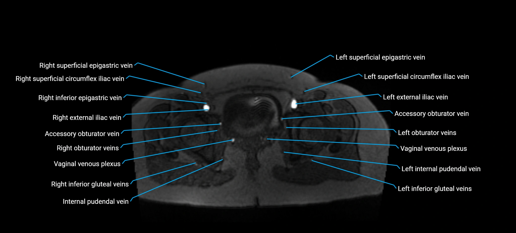 MRV abdomen pelvis & lower limb axial cross sectional anatomy labelled MRI image 182 (1).webp